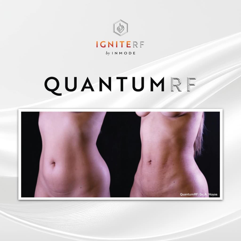 QuantumRF Subdermal Contouring Before and After