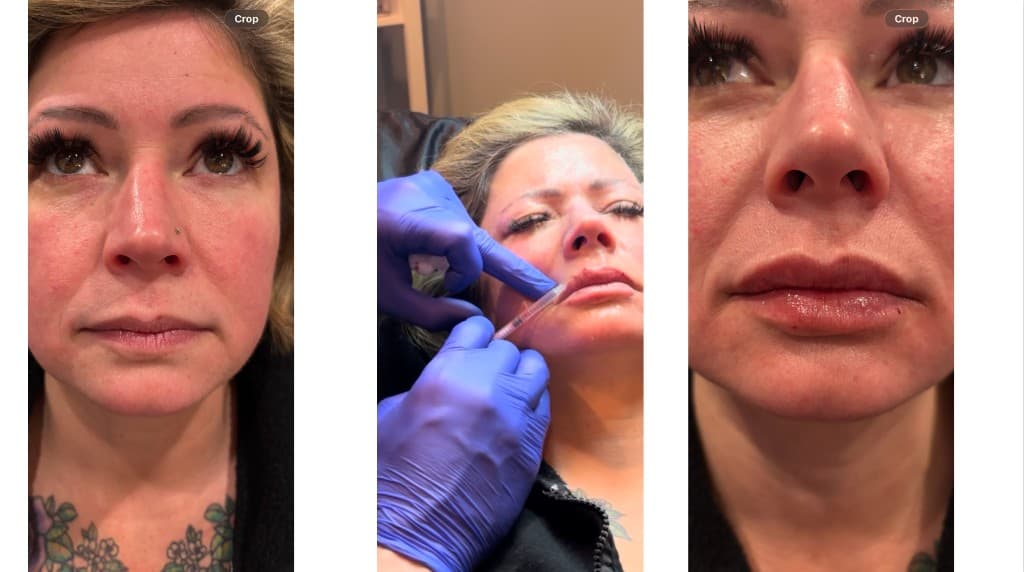 Lip filler before, during injection, and after — Hello Gorgeous Med Spa Oswego IL