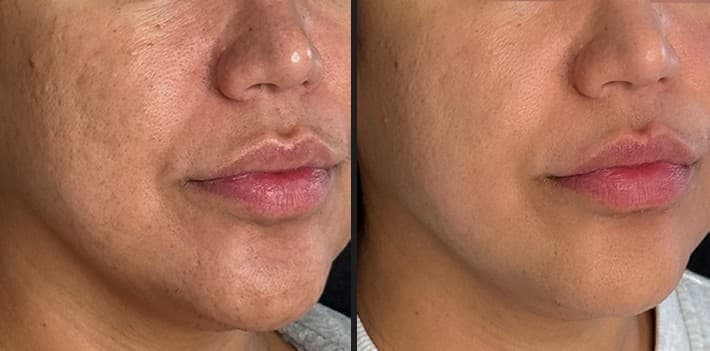 Luxora InMode skin tightening before and after — Hello Gorgeous Med Spa Oswego IL