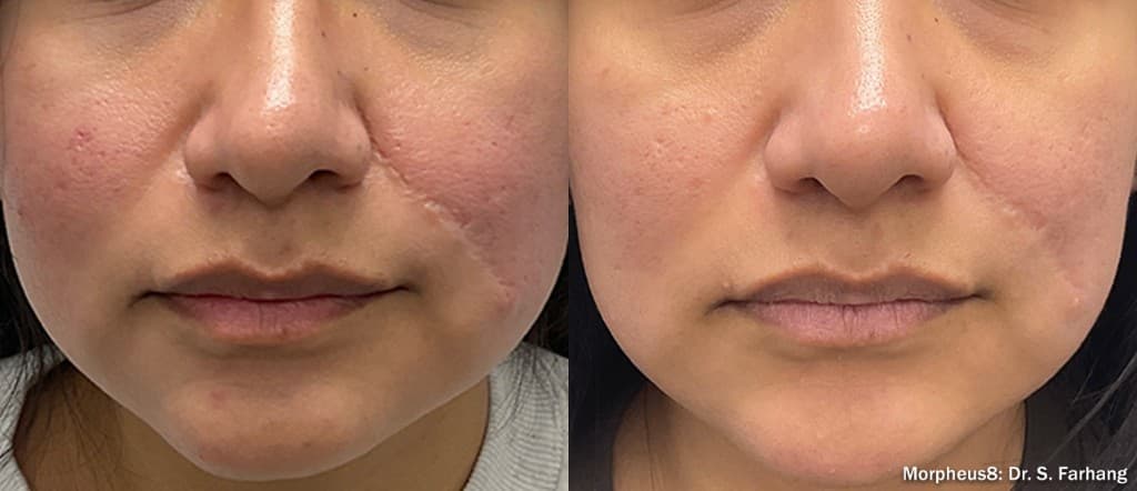 Morpheus8 acne scars and redness before and after — Hello Gorgeous Med Spa Oswego IL