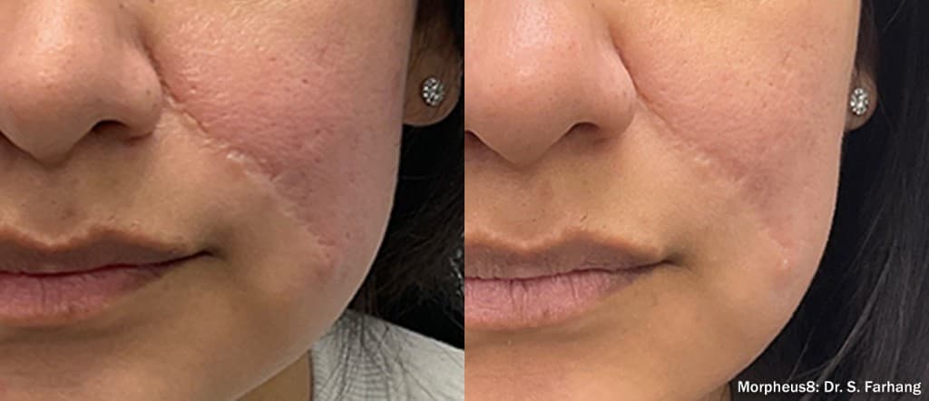Morpheus8 surgical scar and acne scars before and after — Hello Gorgeous Med Spa Oswego IL