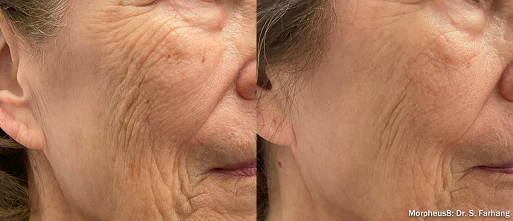 Morpheus8 face wrinkles fine lines before and after — Hello Gorgeous Med Spa Oswego IL