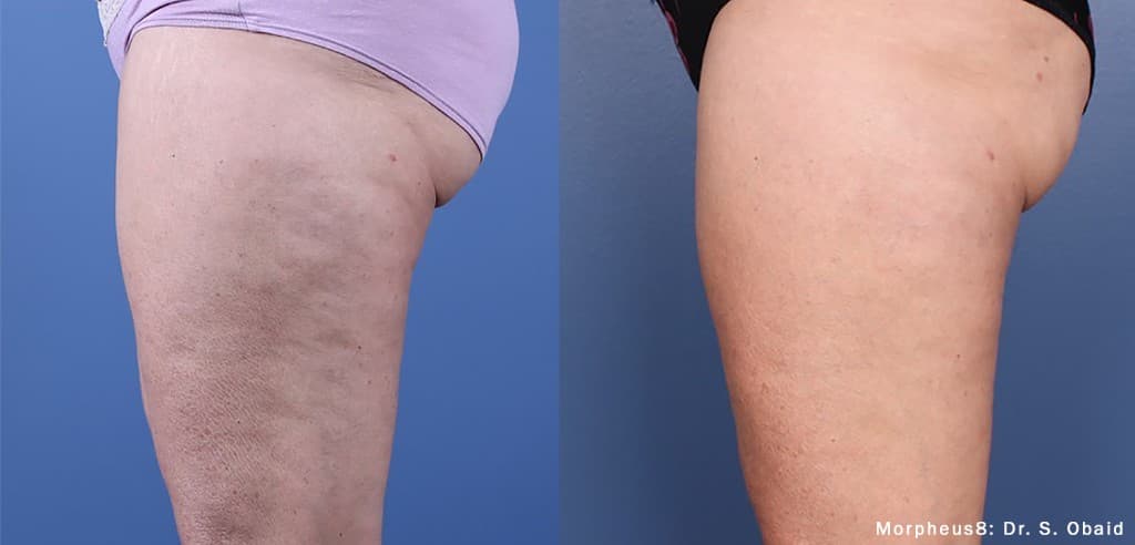 Morpheus8 Burst body contouring thigh before and after — Hello Gorgeous Med Spa Oswego IL