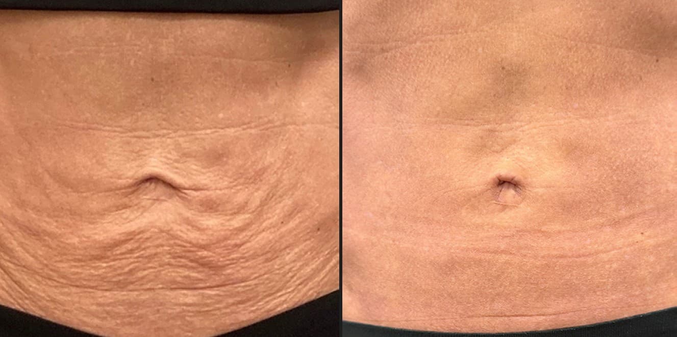 Quantum RF face and neck before and after — Hello Gorgeous Med Spa Oswego IL
