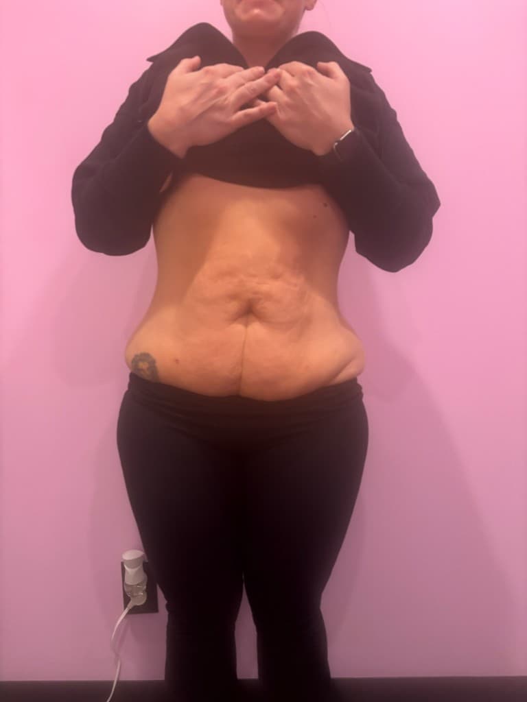 Quantum RF — Body Contouring after — Hello Gorgeous Med Spa Oswego IL