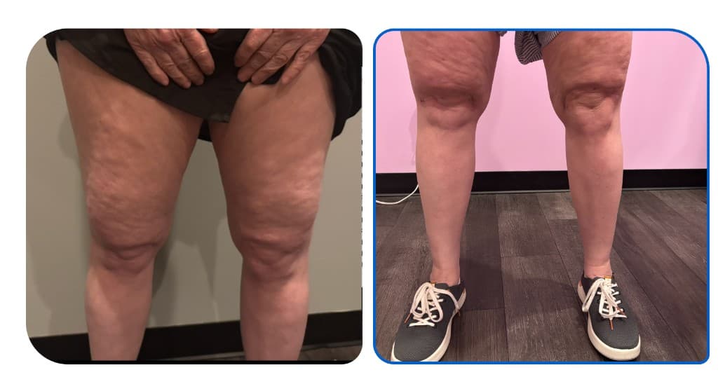 Quantum RF before and after thighs and knees skin tightening Hello Gorgeous Med Spa Oswego IL