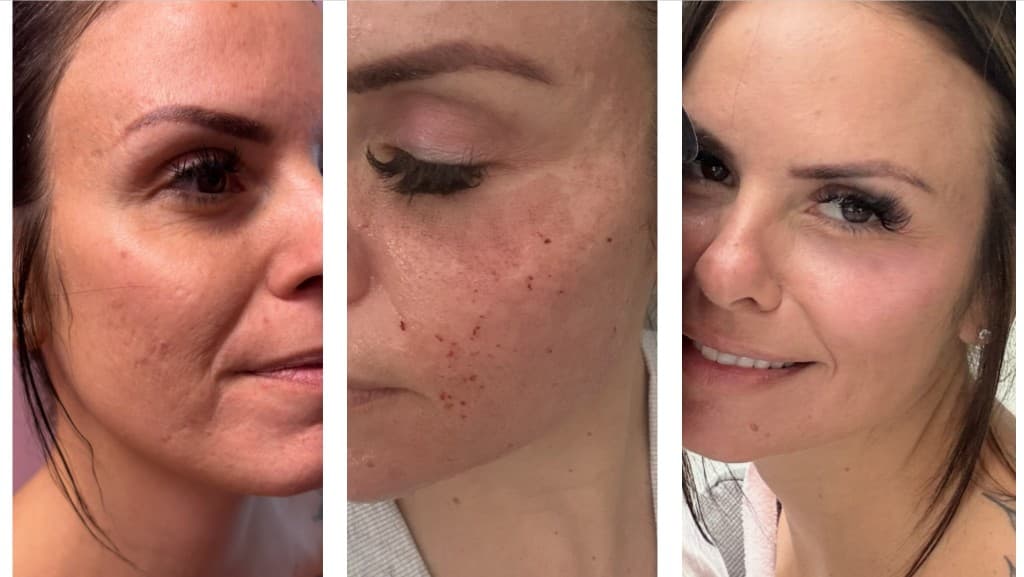 Solaria CO₂ laser before, during, and after — Hello Gorgeous Med Spa Oswego IL