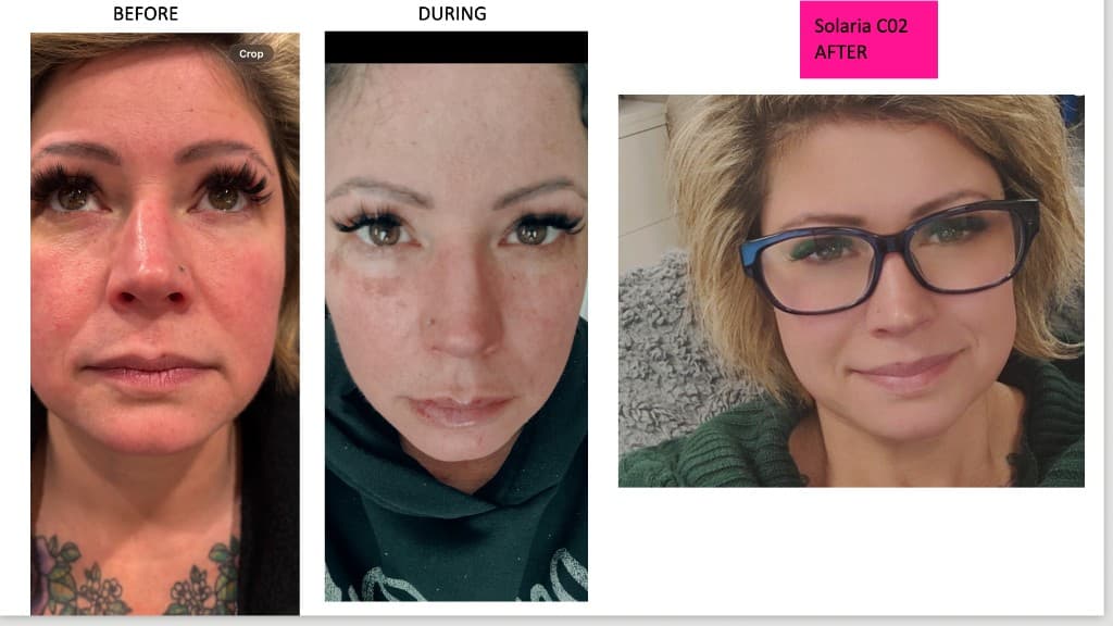 Solaria CO₂ laser before, during, and healed after — Hello Gorgeous Med Spa Oswego IL