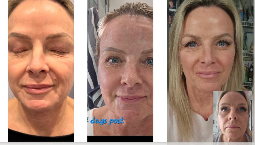 Solaria CO₂ laser before, 4 days post, and healed after — Hello Gorgeous Med Spa Oswego IL