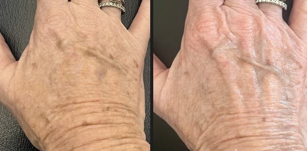 Solaria CO₂ laser skin renewal before and after — Hello Gorgeous Med Spa Oswego IL