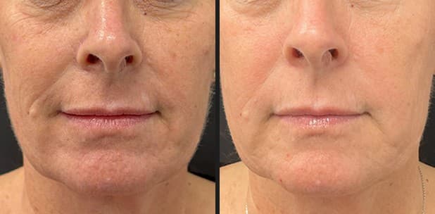 Solaria CO₂ pores and texture before and after — Hello Gorgeous Med Spa Oswego IL