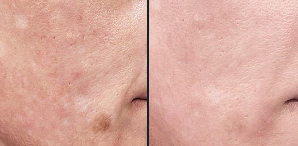 Solaria CO₂ melasma and dark spots before and after — Hello Gorgeous Med Spa Oswego IL