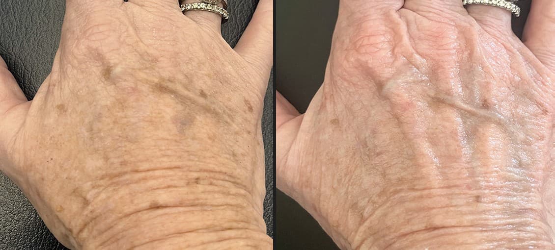 Solaria CO₂ laser before and after — Hello Gorgeous Med Spa Oswego IL