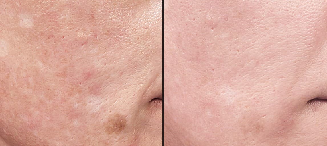 Solaria CO₂ laser skin tone and radiance before and after — Hello Gorgeous Med Spa Oswego IL