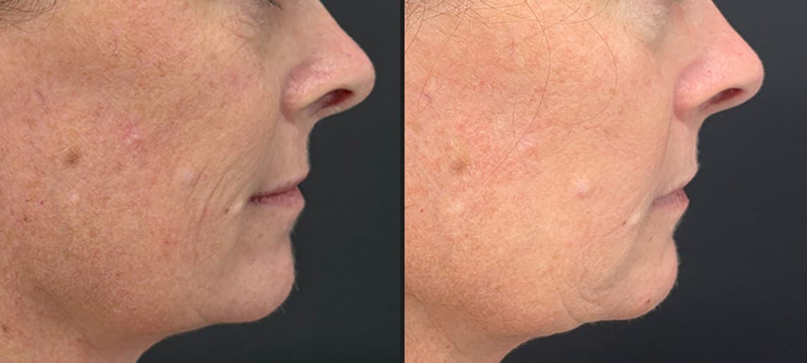 Solaria CO₂ laser sun damage and aging before and after — Hello Gorgeous Med Spa Oswego IL