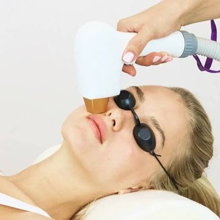IPL photofacial treatment at Hello Gorgeous Med Spa in Oswego