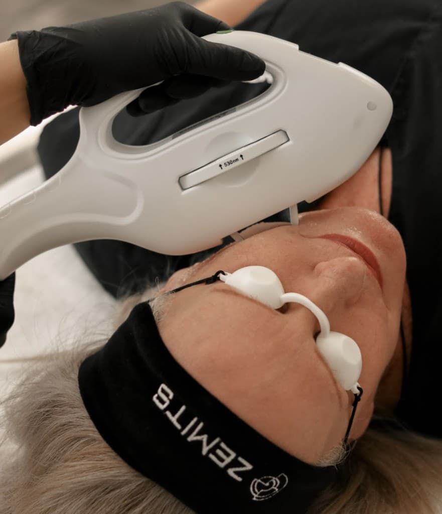 IPL Photofacial treatment in progress at Hello Gorgeous Med Spa Oswego, IL — Zemits 530nm intense pulsed light handpiece treating face for sun damage and pigmentation