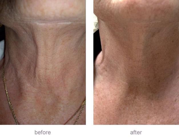 Morpheus8 neck tightening before and after