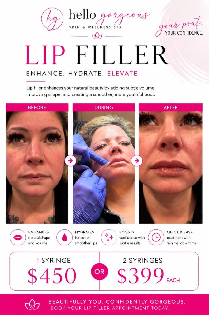 Lip filler before, during, and after at Hello Gorgeous Med Spa Oswego — $450 one syringe or $399 each for two syringes