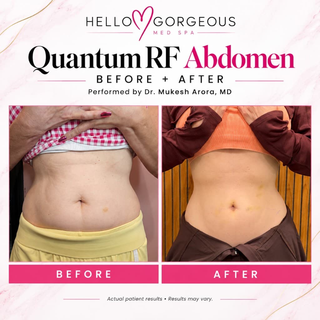 Quantum RF abdomen front view before and after — performed by Dr. Mukesh Arora, MD at Hello Gorgeous Med Spa Oswego