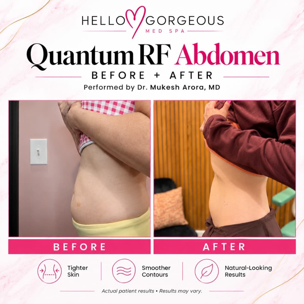 Quantum RF abdomen side view before and after — performed by Dr. Mukesh Arora, MD at Hello Gorgeous Med Spa Oswego