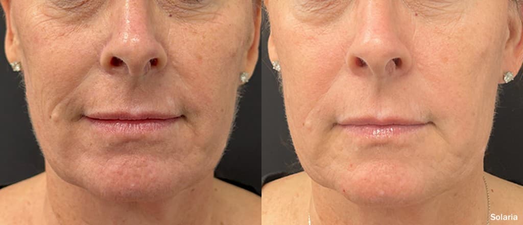 Solaria CO2 full face before and after