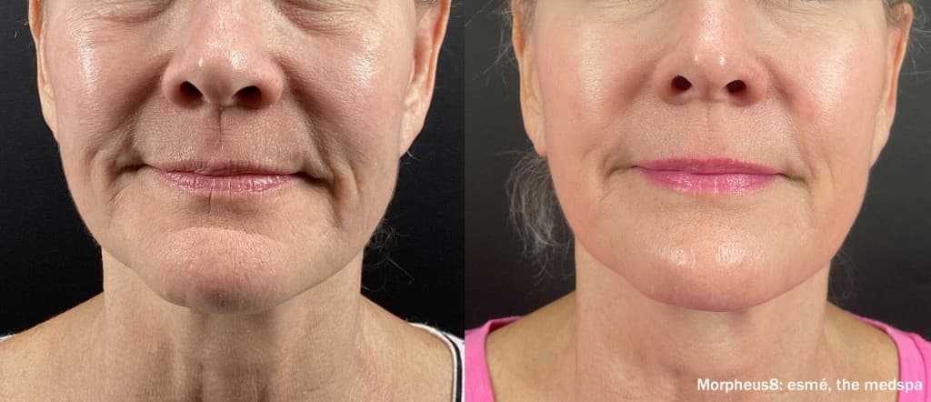 Morpheus8 full face before and after