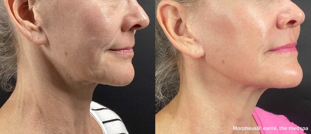 Morpheus8 jawline and neck before and after